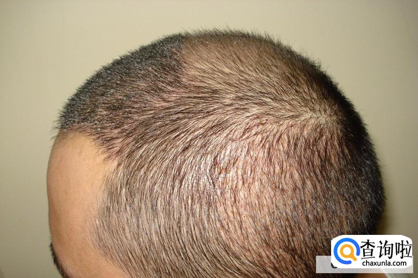 植发能不能一劳永逸