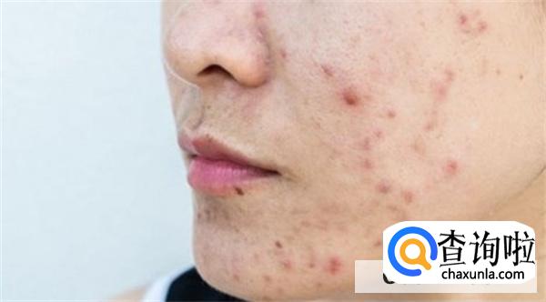 维生素B2可以祛痘吗