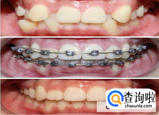 龅牙矫正的年龄是什么时候