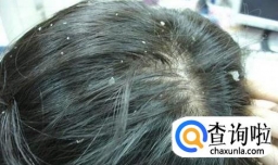 不用洗发液，用洋葱、生姜治头皮屑