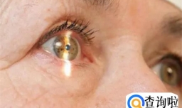 青光眼的症状和表现是什么