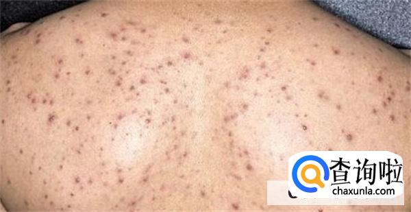 背后长很多痘痘怎么办