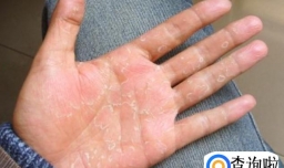 厕所清洁剂对皮肤有伤害吗