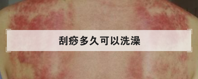 刮痧多久可以洗澡