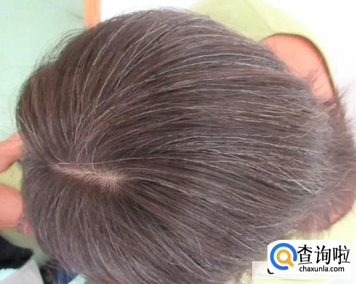 治疗白发的秘方