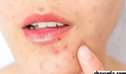 去除痘痘合适的方法