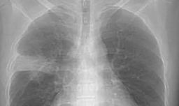 白肺意味着什么 严重吗