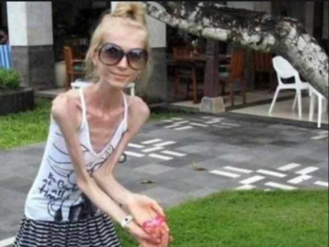 世界上最瘦的人