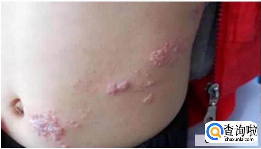 怎么诊断带状疱疹?