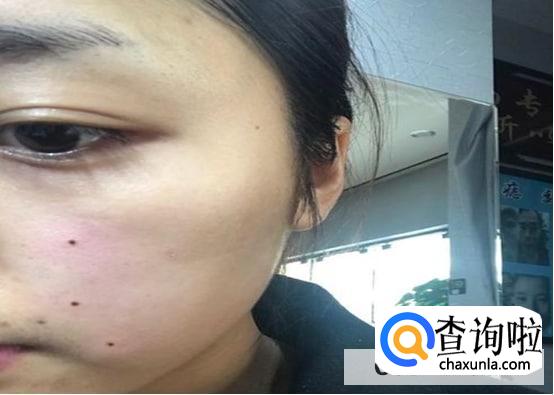 去痣多久可以洗脸