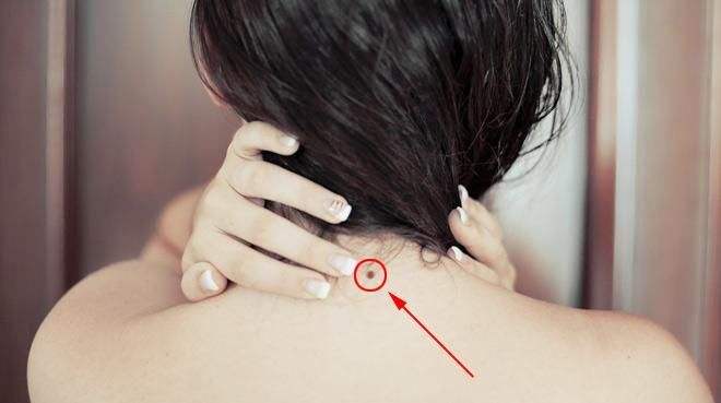 脖子上有痣代表什么