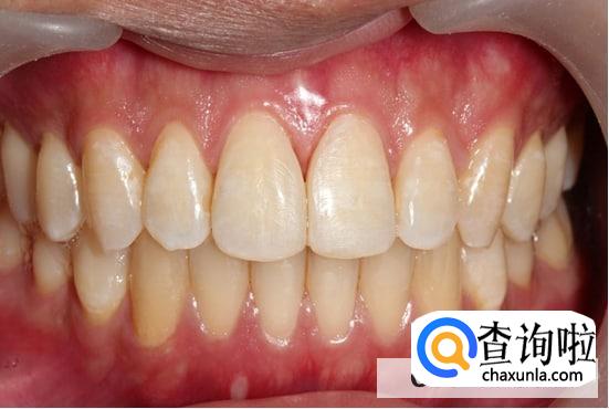 高龄种植牙需要知道的事情