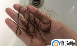 怎么算是脱发
