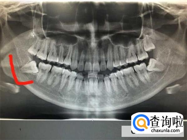 拔横生的智齿会瘦脸吗