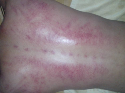 刮痧多久可以洗澡