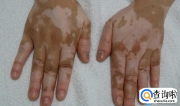 白斑怎么治才能根除