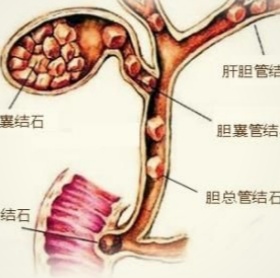  胆结石最佳治疗方法