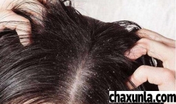 为什么刚洗完头发就痒