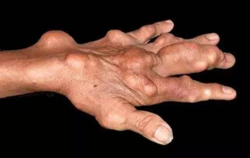 如何有效地对痛风进行护理