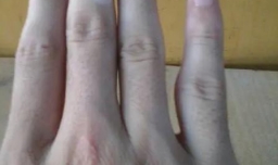 手上有白斑是什么病