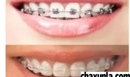 整牙可以怀孕吗