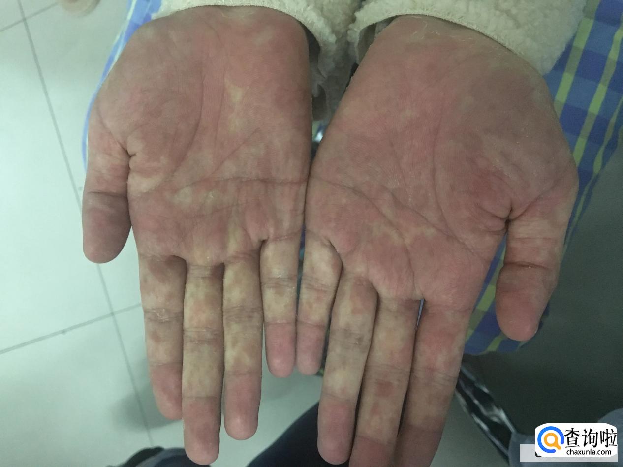 如何治疗干燥综合症