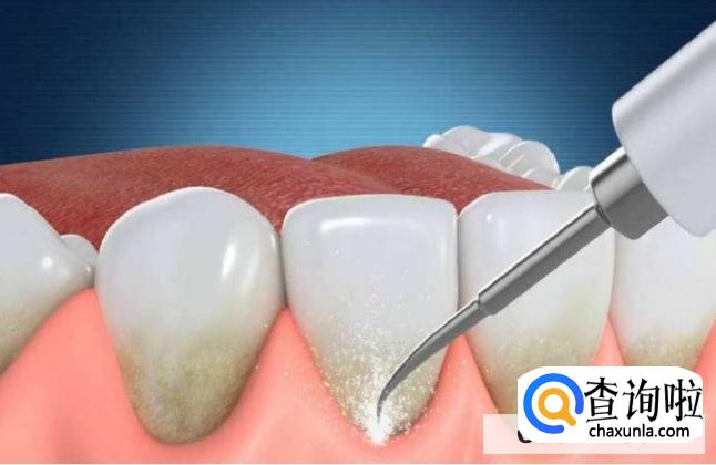 ​洗牙好吗会有副作用吗