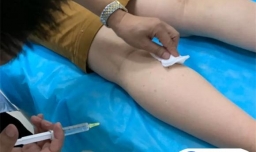 瘦腿针多少钱打一针 维持多久效果