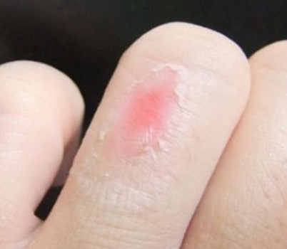 烫伤之后要注意点啥