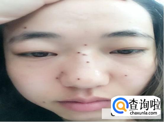 去痣多久可以洗脸