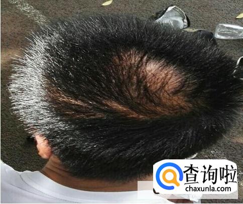 熬夜真的会秃头吗