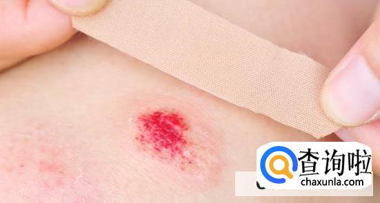 日常处理小伤口的正确步骤