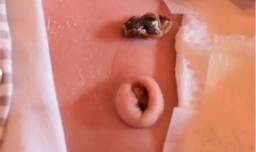 宝宝脐带脱落后，有点渗血怎么办？