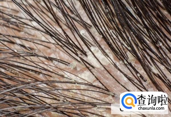 头中间为什么有头皮