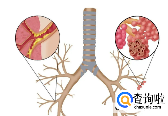 吸烟容易患肺气肿吗