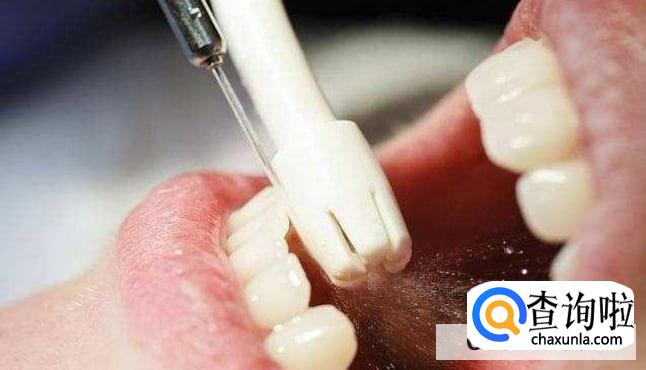 ​洗牙好吗会有副作用吗