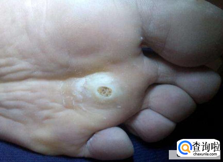 为什么脚上会长鸡眼