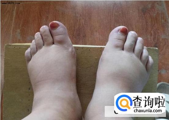 吃什么可以去除水肿